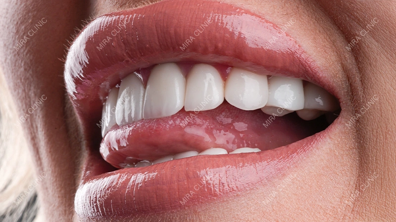 Smile Design Complexity